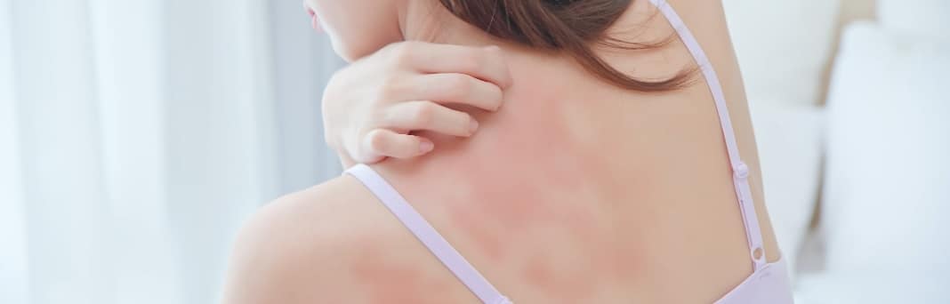 Hives Frisco TX